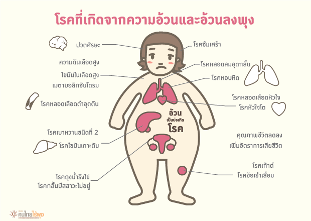 BMI Overweight - Disease